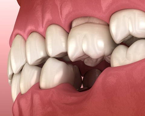 How Long Does It Take For Your Teeth To Shift: Explained