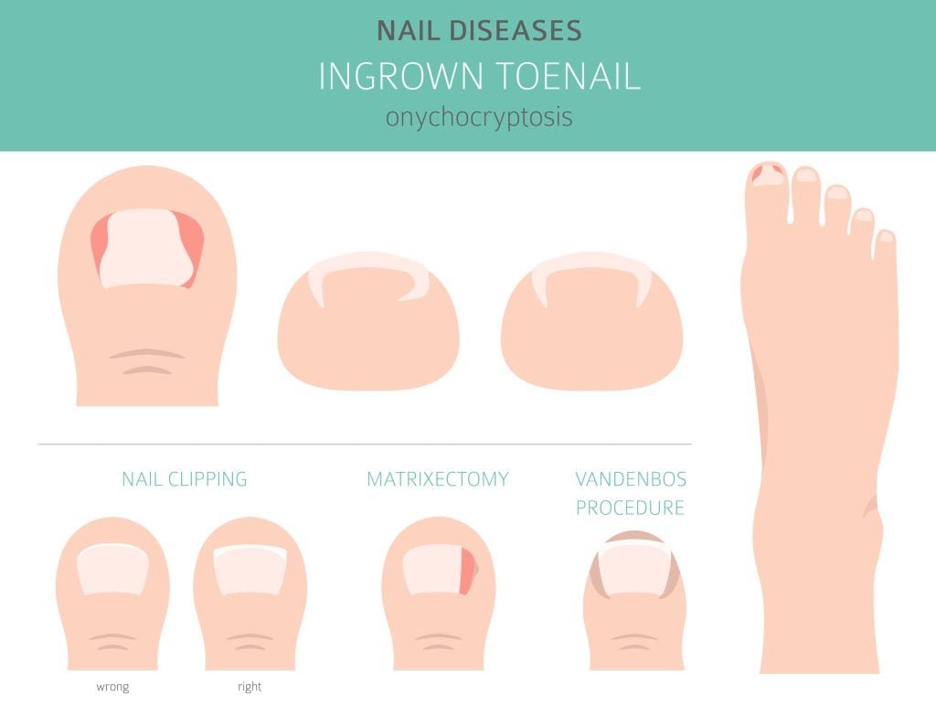 Cost Of Ingrown Toenail Removal: How Much Does It Cost?